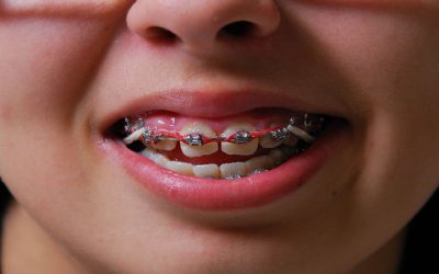A Few Helpful Tips for Clear Aligner Treatment in Medina, Ohio